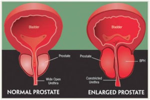 Prostate Surgery