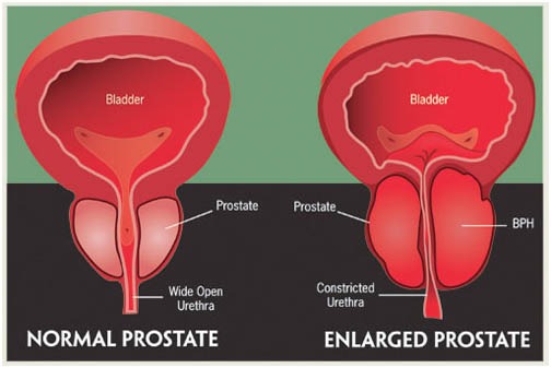 prostate health